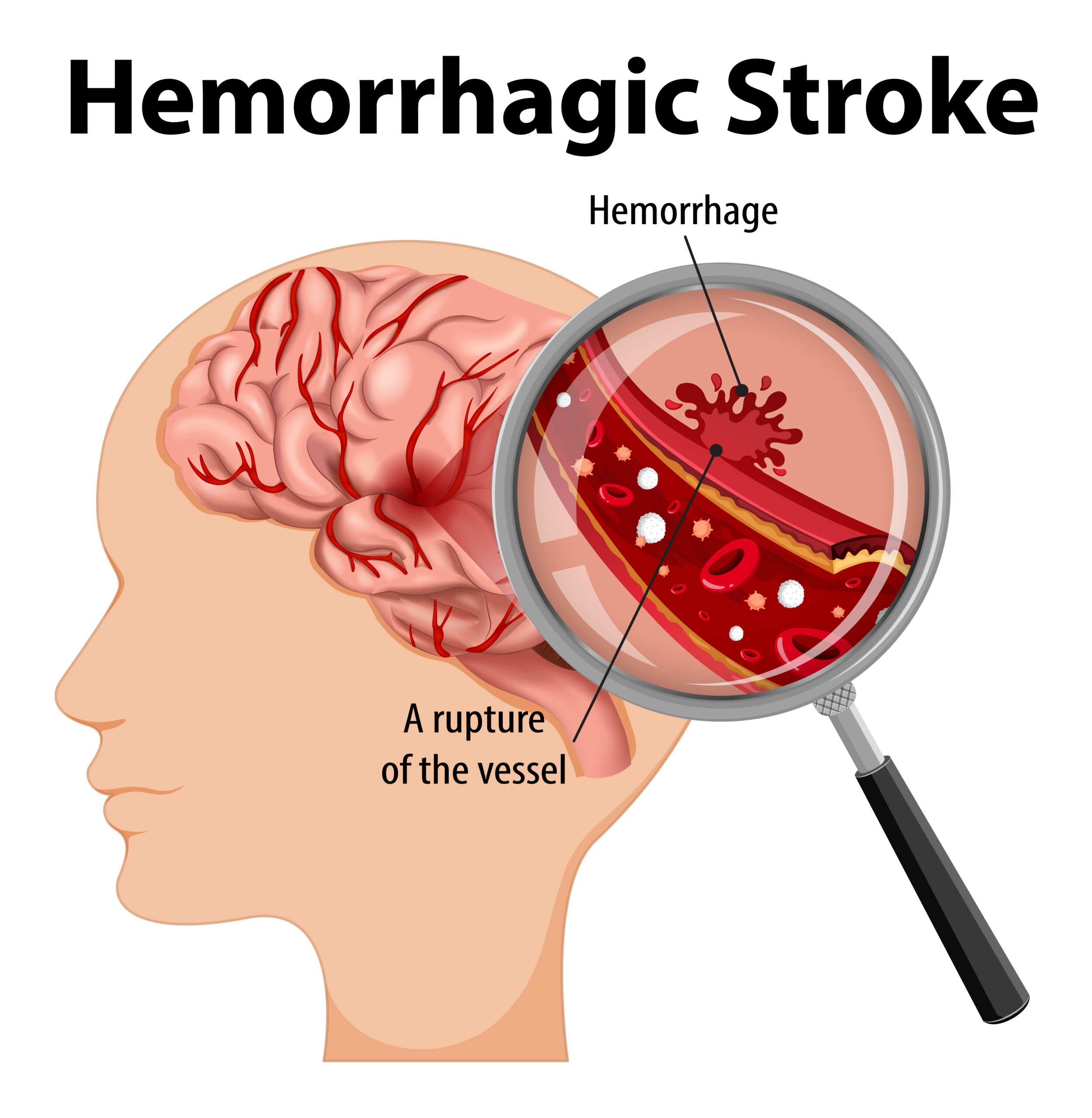 Acidente Vascular Cerebral Hemorrágico (AVCH)