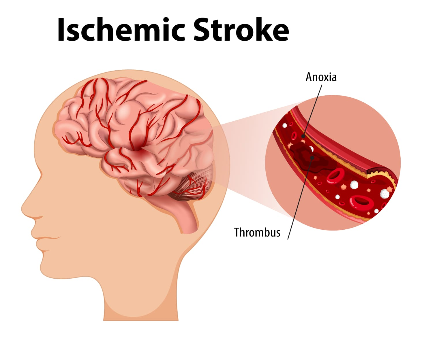 Acidente Vascular Cerebral Isquêmico (AVCI)